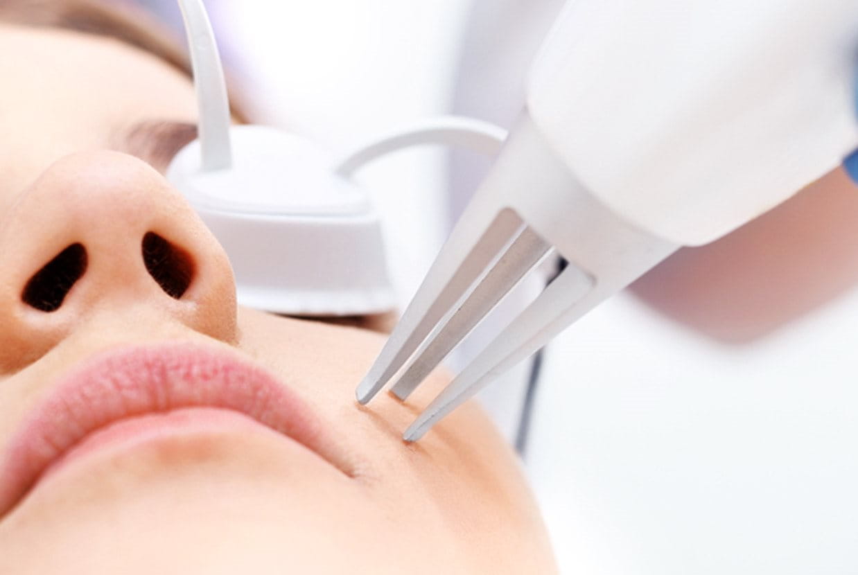 Laserbehandeling: laserbehandeling van de huid