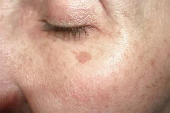 Qu'est-ce que la thérapie au laser ? | EUCERIN