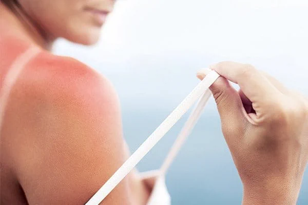 Minor Burns Skin Regeneration Eucerin