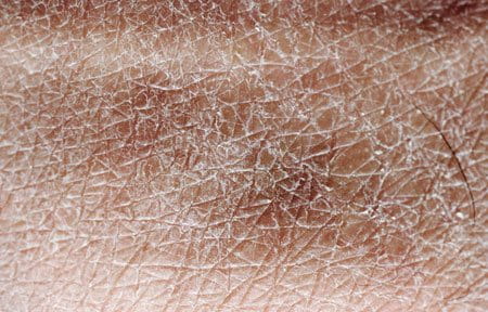 Close-up from dry skin