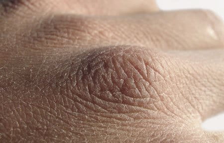 Close-up from back of the hand with dry skin