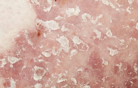 Nahaufnahme der Hauterkrankung Psoriasis