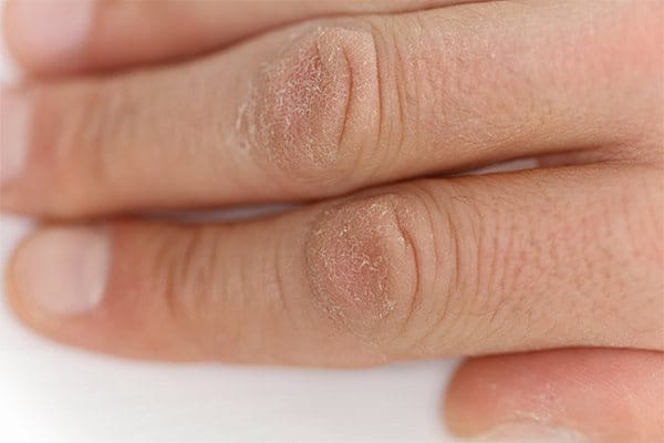 Сухата кожа на ръцете обикновено първо се появява на кокалчетата.