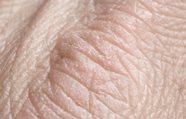 Schilferige Huid Symptomen Behandeling Eucerin Schilferige Huid Symptomen Behandeling Eucerin
