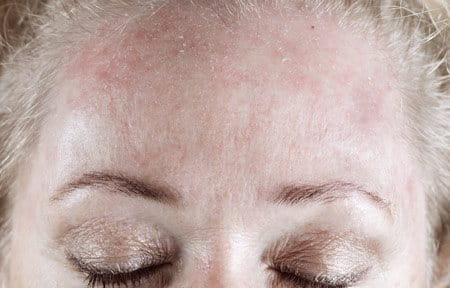 Woman´s forehead with red and scaly skin