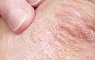 Schilferige Huid Symptomen Behandeling Eucerin Schilferige Huid Symptomen Behandeling Eucerin