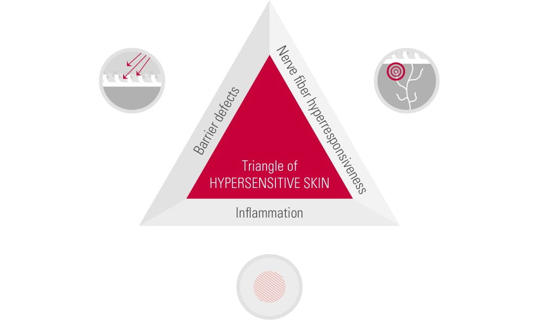 Triangle of hypersensitive skin