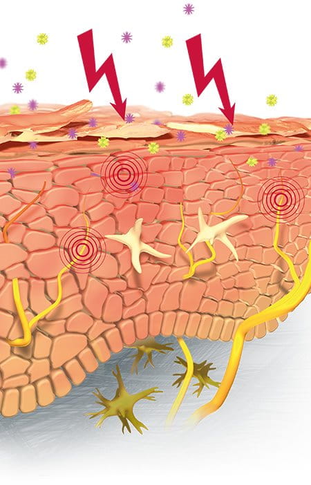 Illustration of hypersensitive skin's compromised barrier.