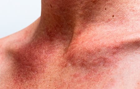 Photograph of redness on a man's neck.