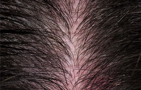 cuoio capelluto sensibile e iper-sensibile, causa di disagio
