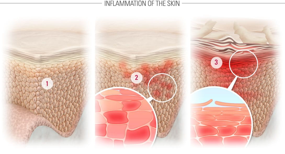 Illustration of healthy skin, microinflammation and inflammation