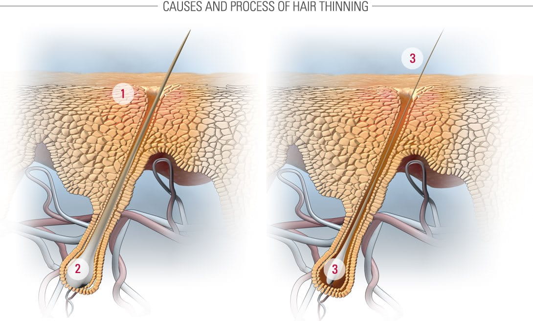Thinning hair and hair loss | Causes and symptoms | Eucerin