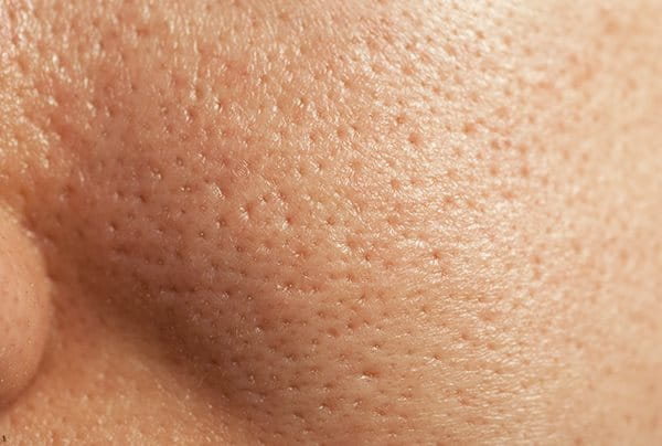 for acne and oily skin