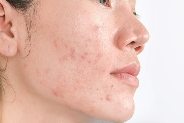 manchas de acne y sol