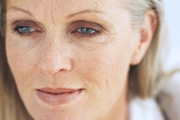 woman with photoaging