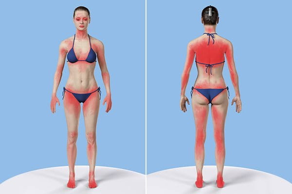 Bild som illustrerar områden på kroppen som ofta missas gällande solskydd