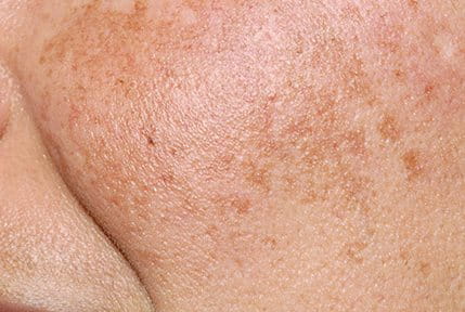 Zonnevlekjes op de rechter wang | Eucerin