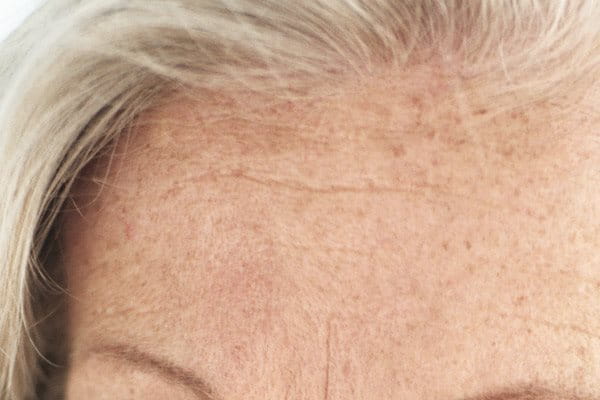 Старческите петна често се появяват по лицето