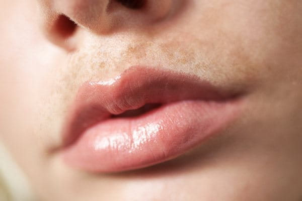 Хиперпигментацията над горната устна може да се появи в резултат на хормонални промени