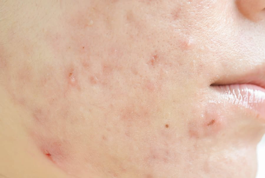 Marcas de granos y cicatrices causadas por el acné