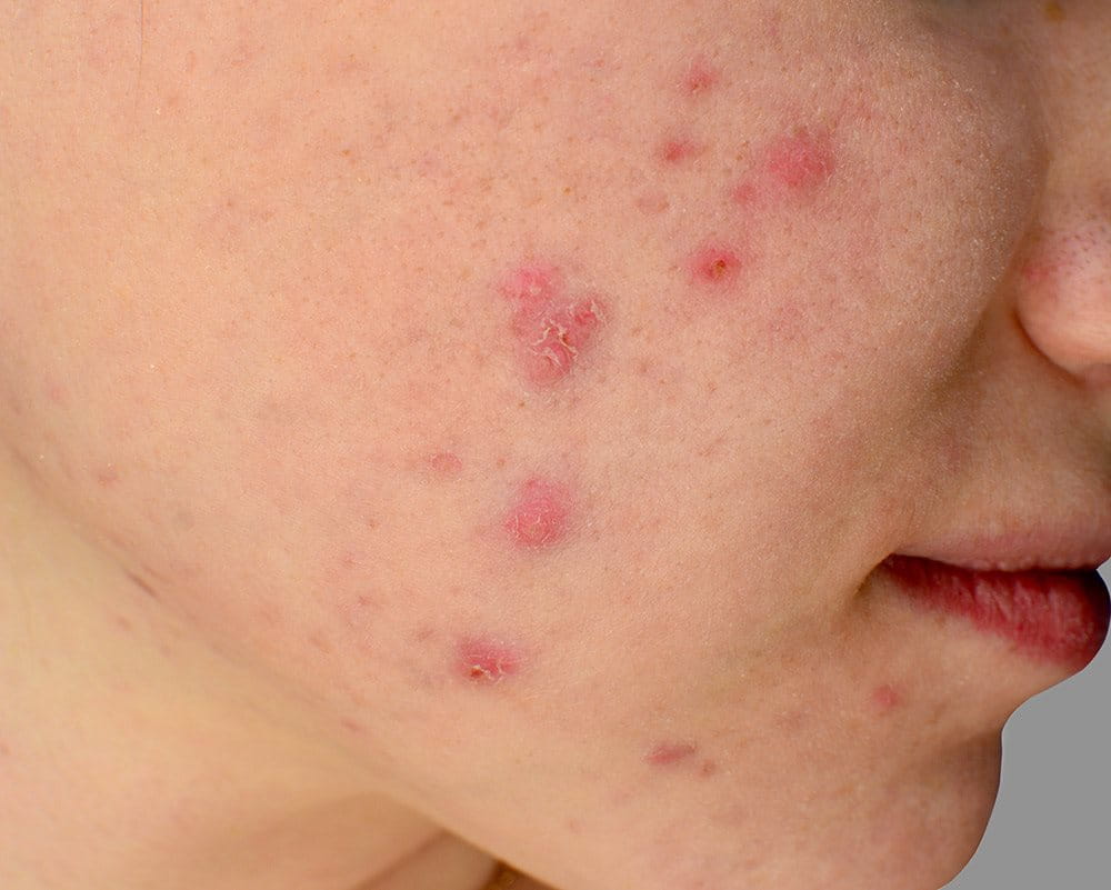Pasivo acidez malicioso Marcas de granos I las consecuencias de l acné I Eucerin