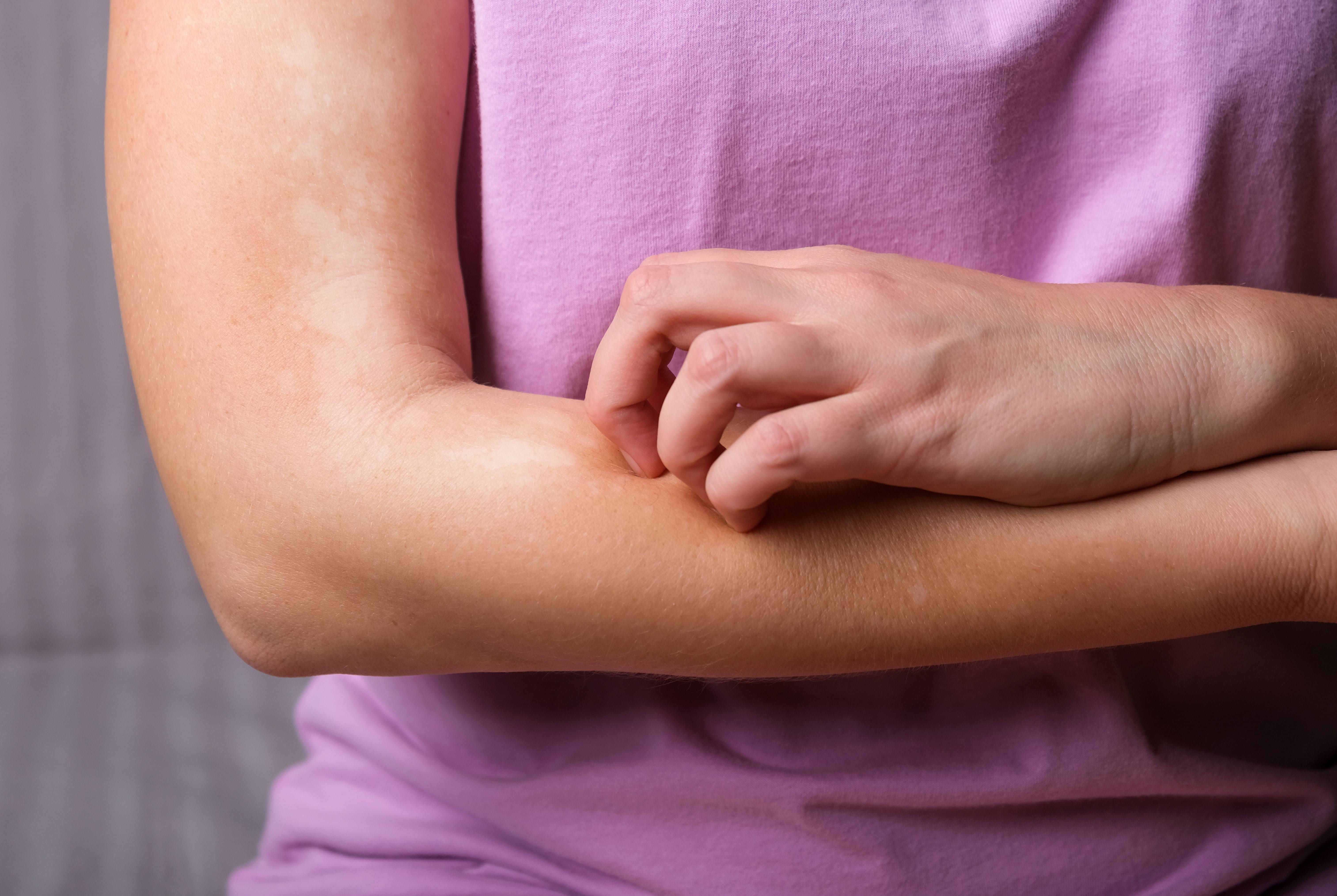 Frau kratzt sich am Unterarm