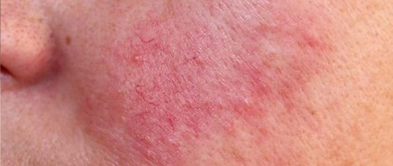 Rosacea: Ursachen Und Behandlung | Eucerin