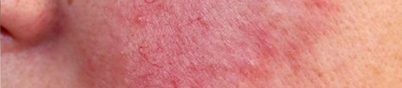 Von Rosacea betroffene Wangenpartie im Gesicht