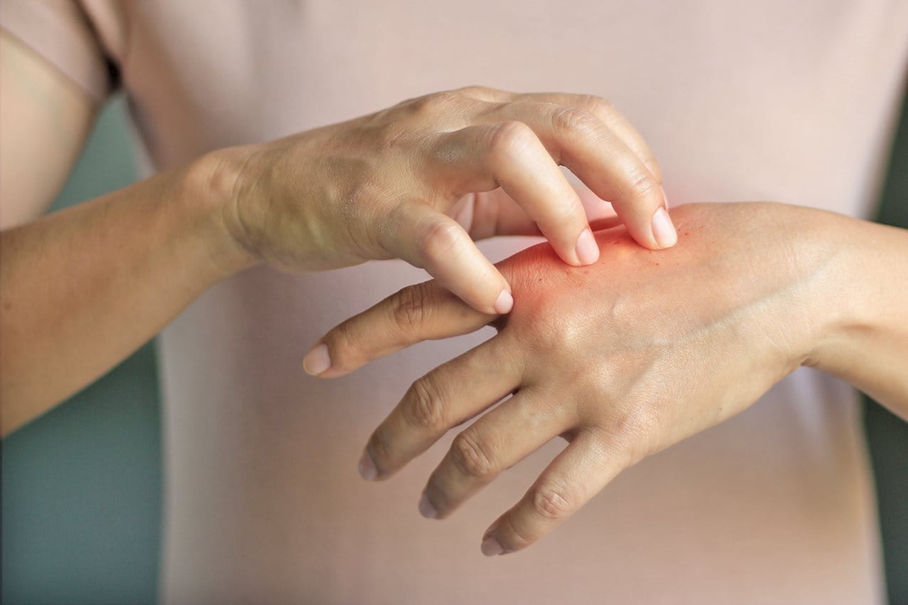 Trockene Zu Ekzemen Neigende Hande Was Hilft Eucerin