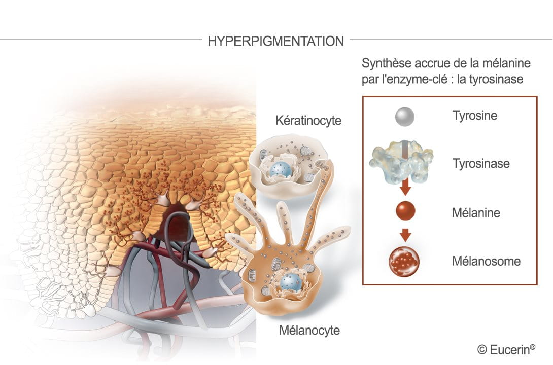 hyperpigmentation