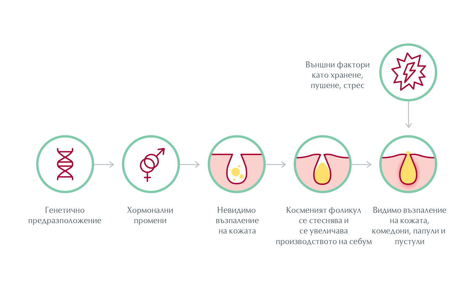 Как се развиват пъпките, папулите и пустулите при възрастовото акне?