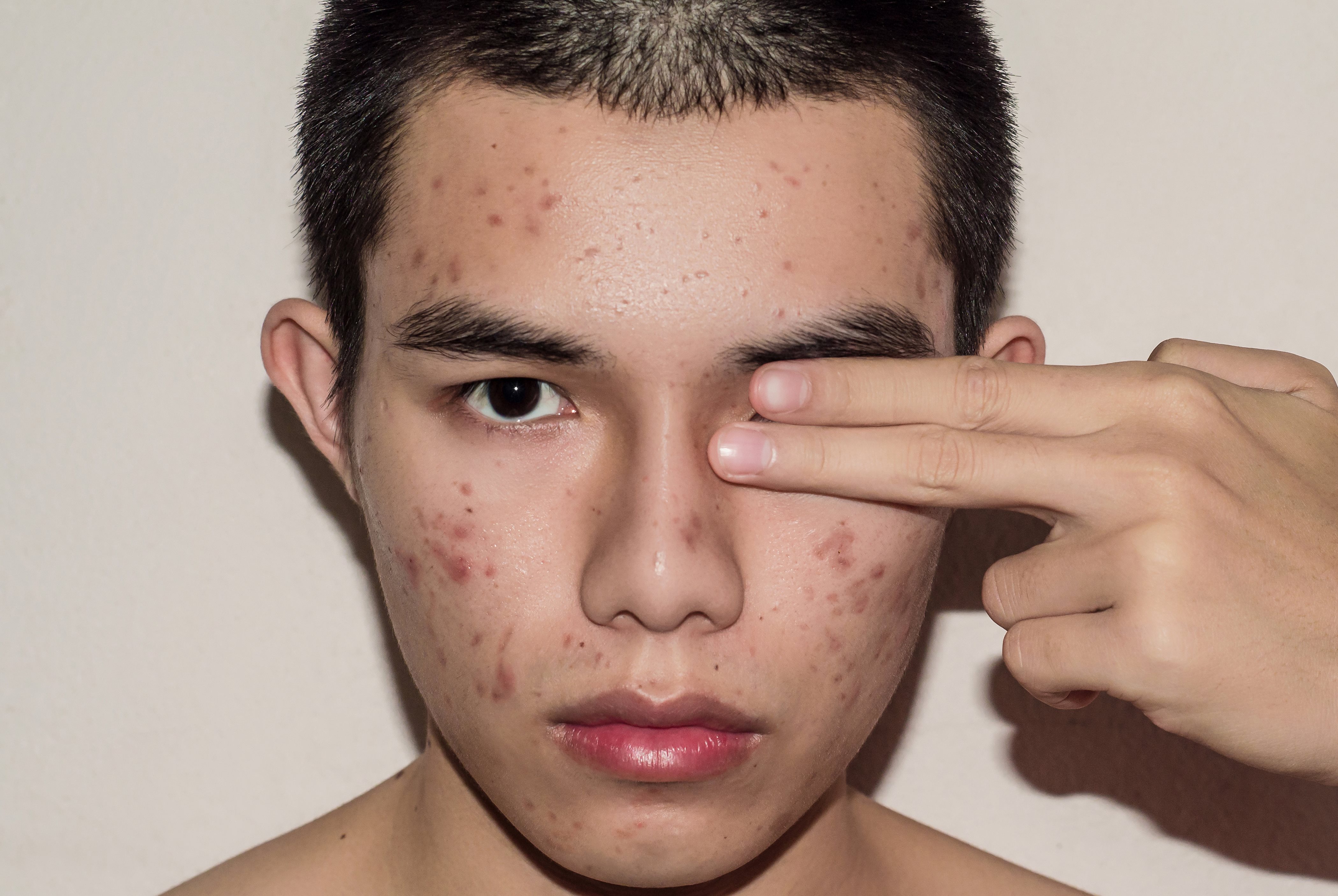 Relação do clima com acnes, cravos e espinhas