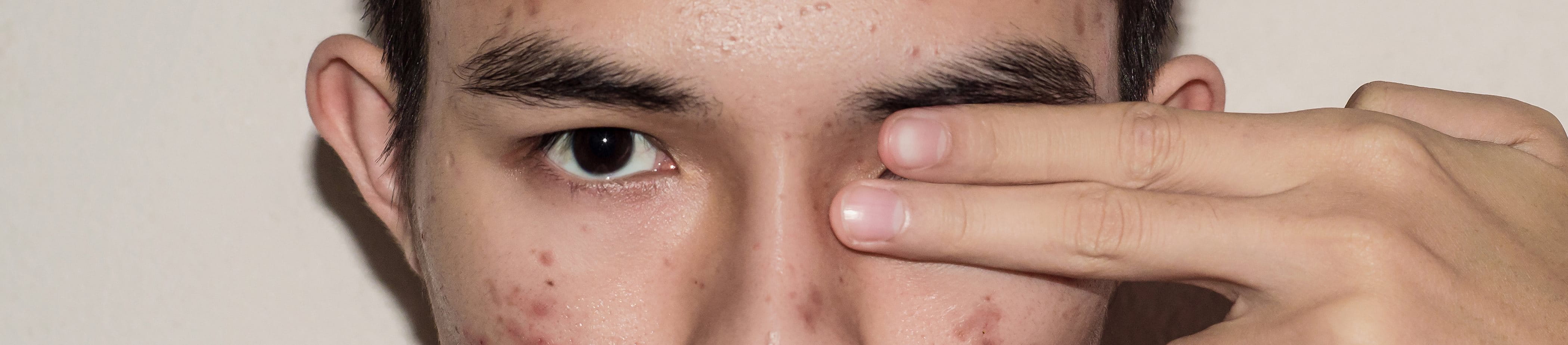 Influência do clima brasileiro na formação de acne, cravos e espinhas.