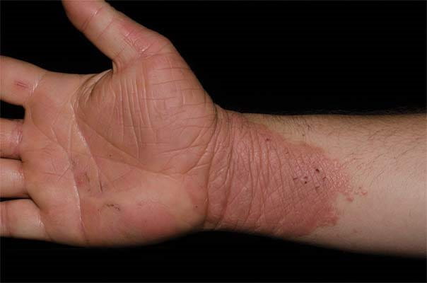 Eczema relief - problème de peau apres