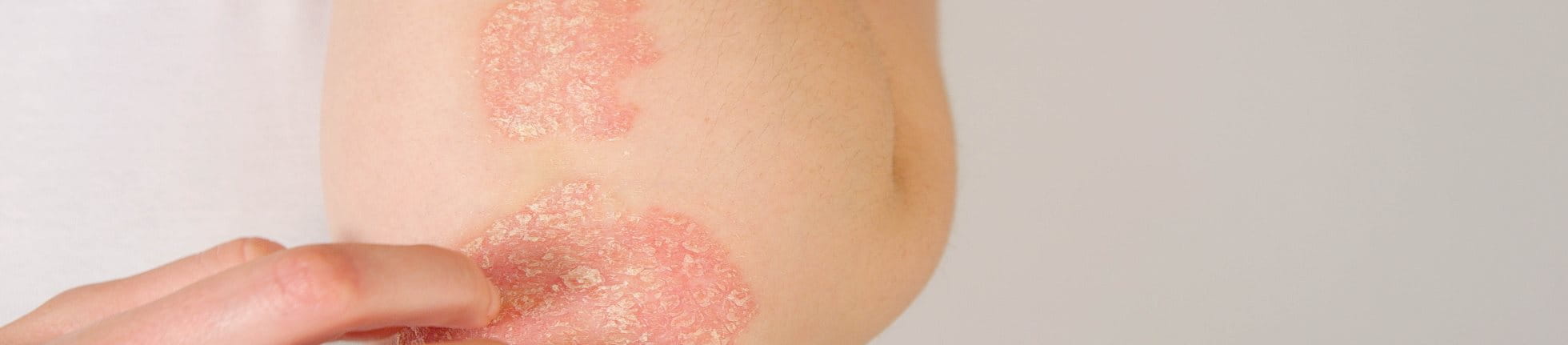 Psoriasis sur le coude et l'avant-bras