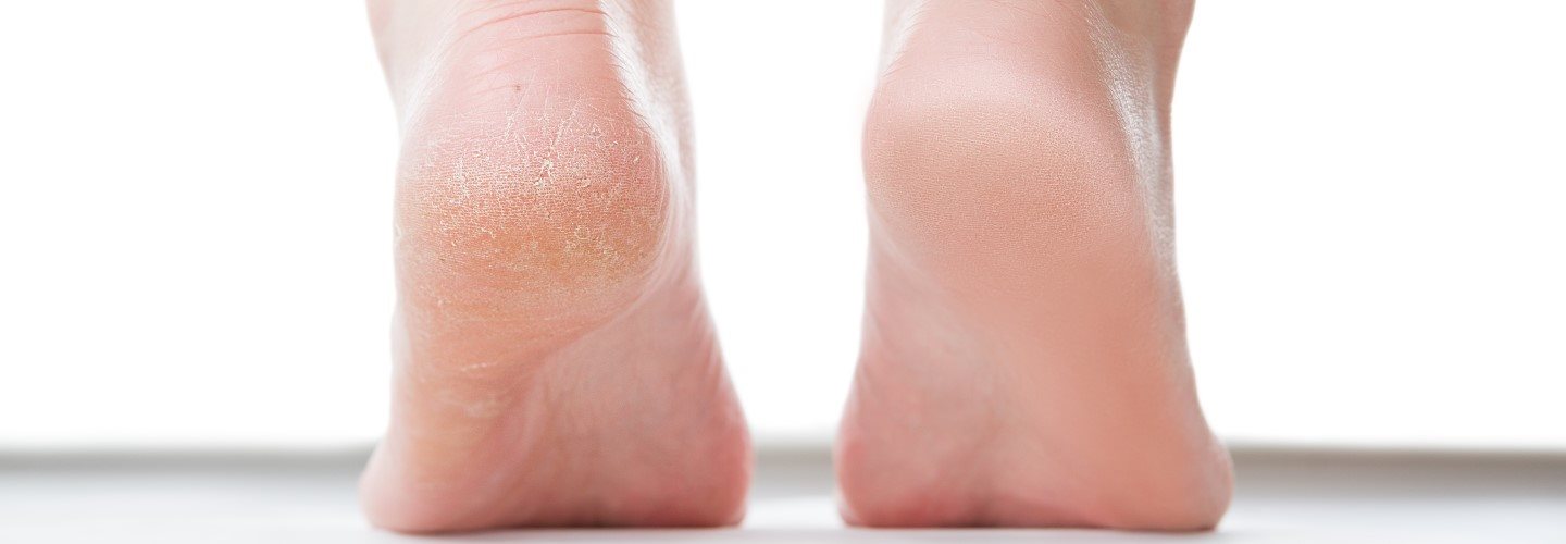 Nahaufnahme von Füssen mit rissigen Fersen.