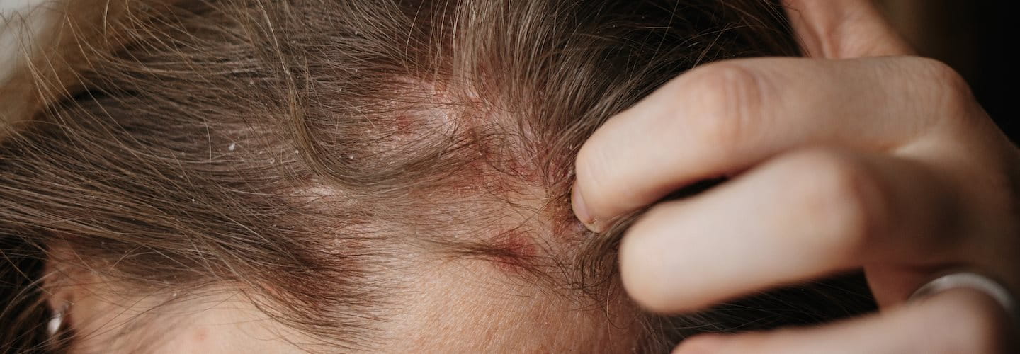 Cuir chevelu avec des pellicules