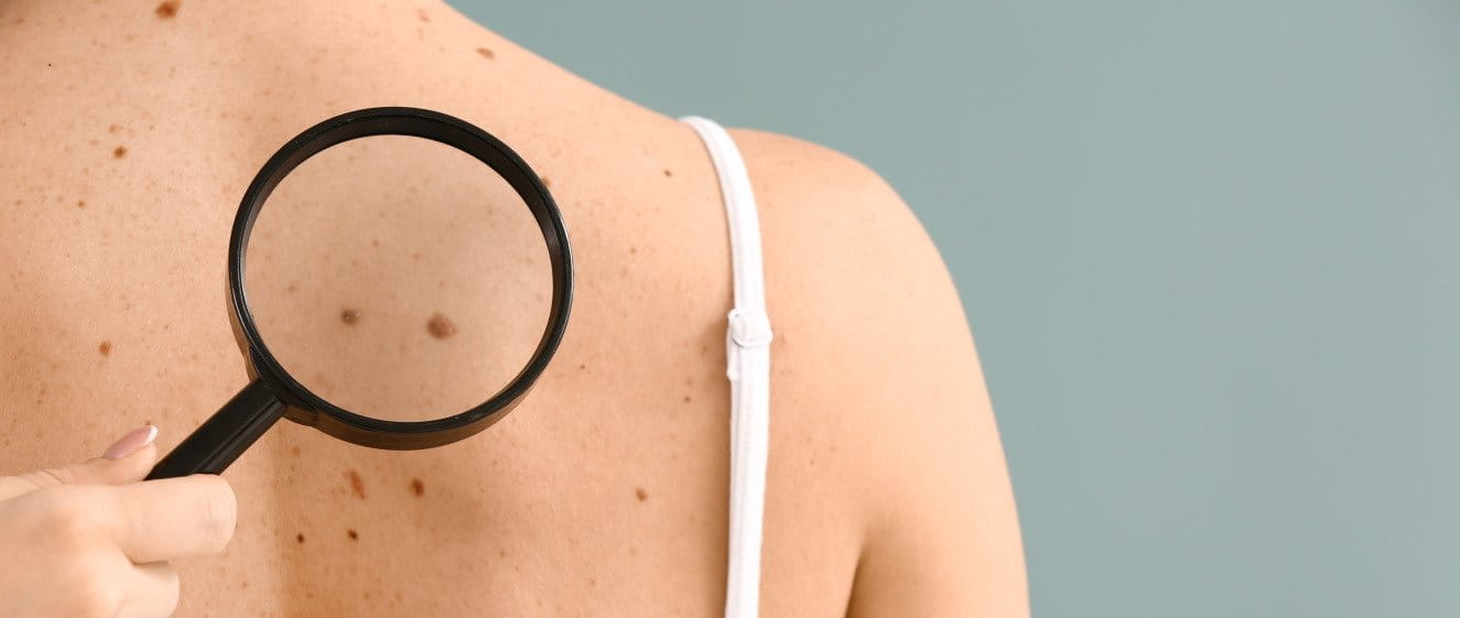 Mit der ABCDE-Regel Muttermale am Rücken untersuchen