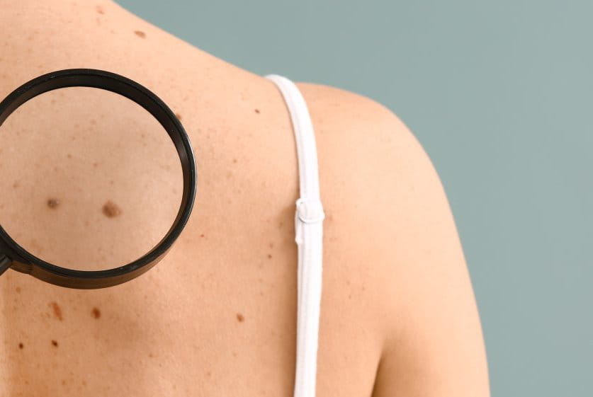 Mit der ABCDE-Regel Muttermale am Rücken untersuchen