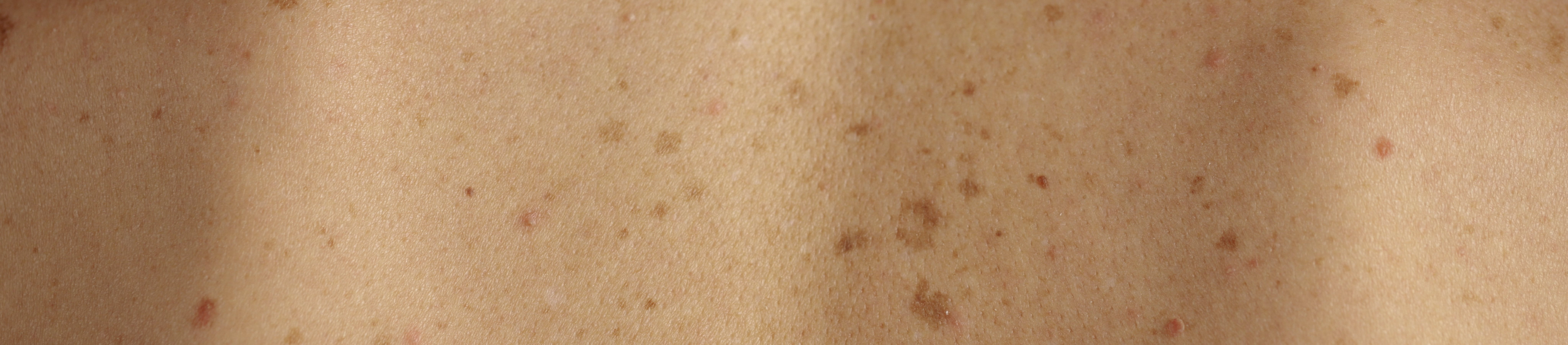 Pigmentflecken am Rücken, Nahaufnahme