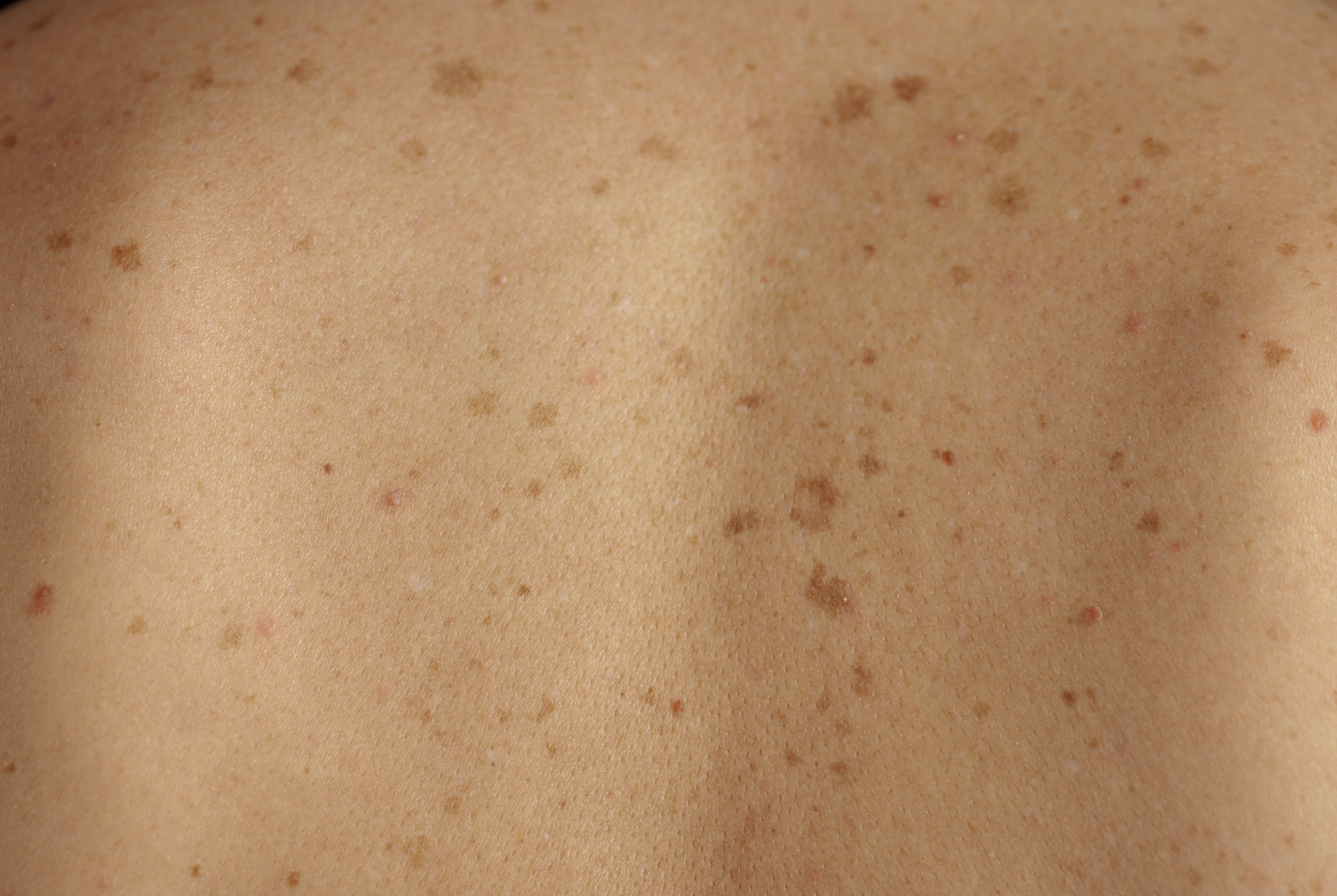 Pigmentflecken am Rücken, Nahaufnahme