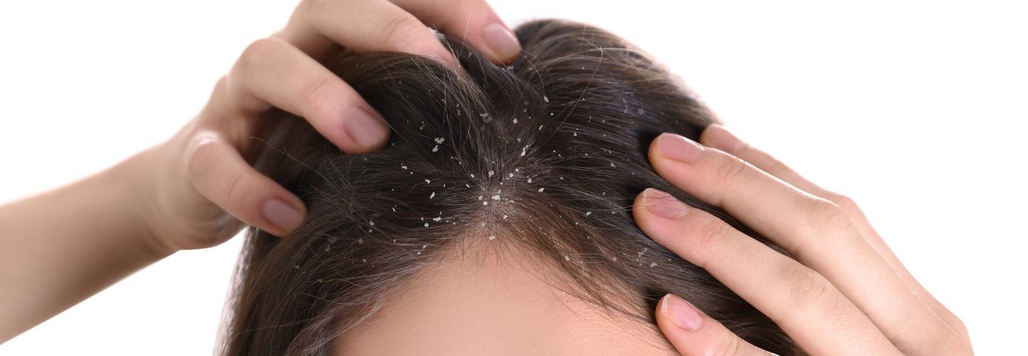 Pellicules grasses sur les cheveux bruns d’une femme