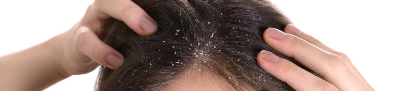 Pellicules grasses sur les cheveux bruns d’une femme