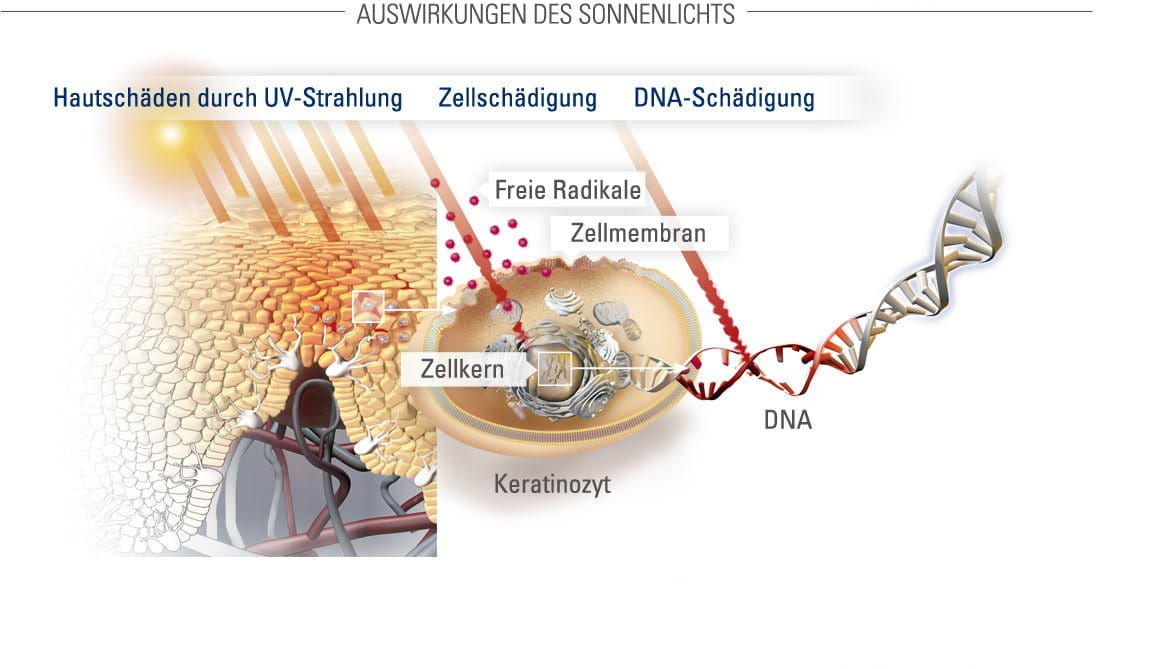 Illustration Hautschäden durch UV-Strahlung