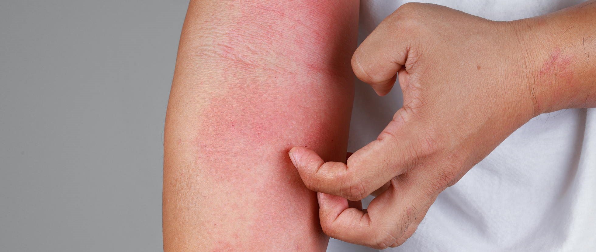 Hautausschlag bei hiv