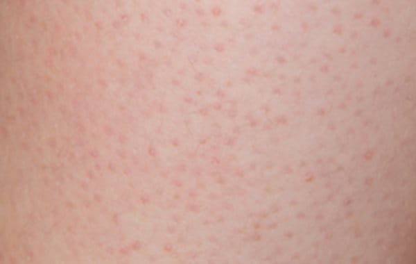 Rote Pickel auf der Haut sind typische Symptome für Reibeisenhaut