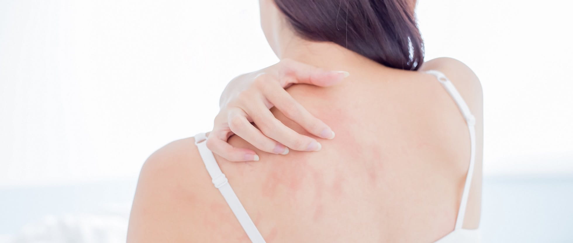 Junge Frau mit Mallorca Akne kratzt sich am Rücken