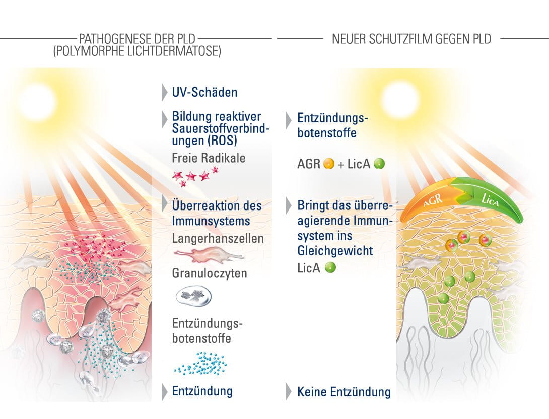 Grafik zur Wirksamkeit von Sonnenschutz bei polymorpher Lichtdermatose