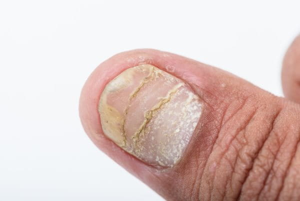 Nagel Psoriasis Schuppenflechte am Fingernagel