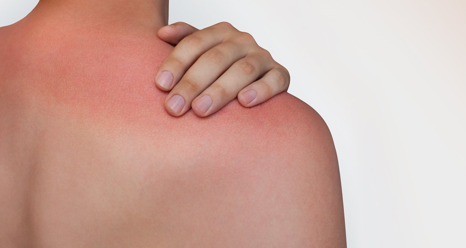 Frau hält sich die schmerzende Schulter mit Sonnenbrand